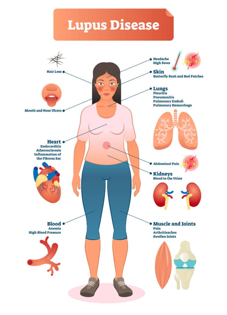 lupus disability, signs of lupus; Lupus disease vector illustration. Labeled diagram with sickness symptoms, like hair loss, high blood pressure, muscle or joints pain and butterfly rash red patches.