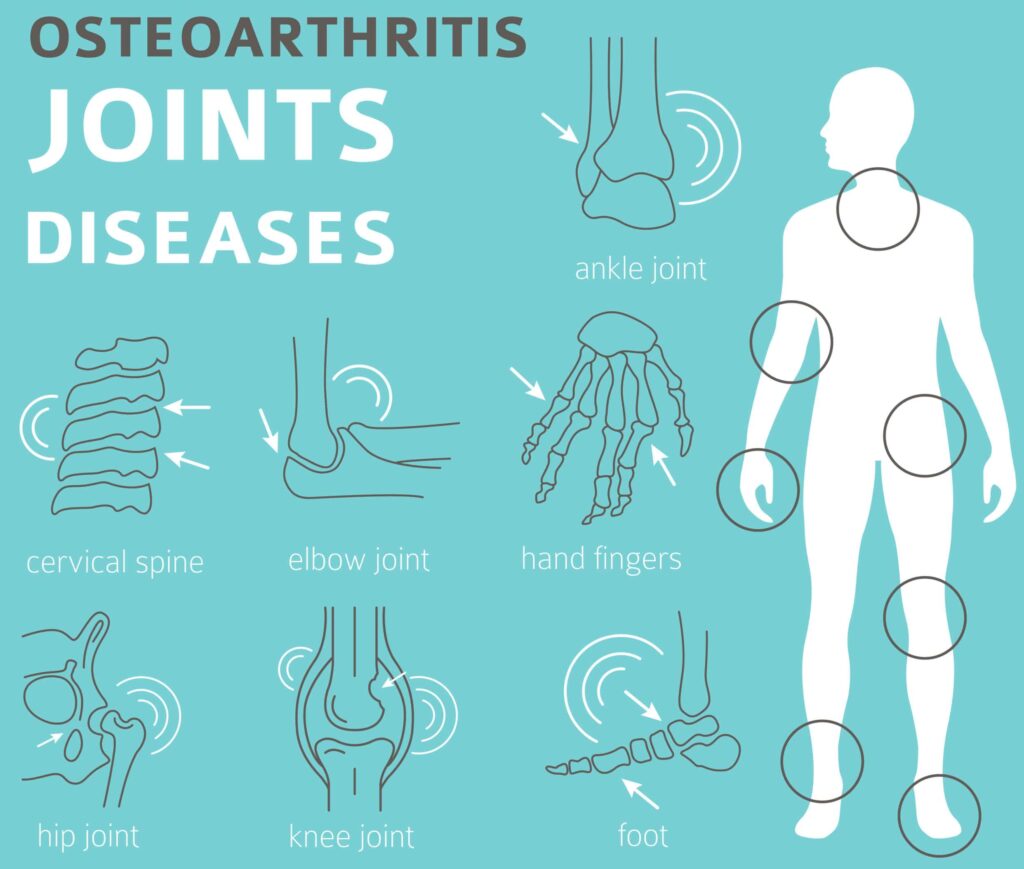 osteoarthritis Joints diseases. Arthritis, osteoarthritis symptoms, treatment icon set. Medical infographic design. Vector illustration