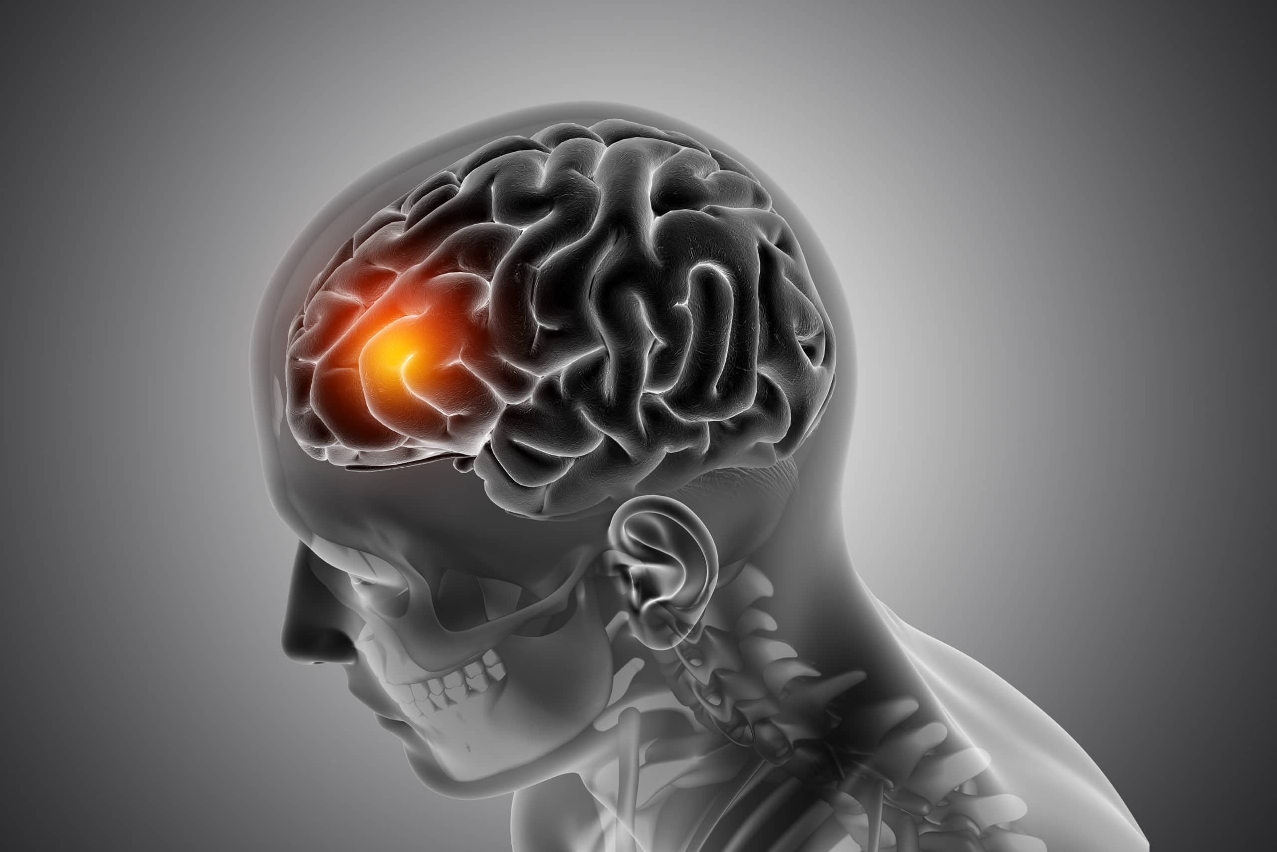 3D render of a male medical figure with front of the brain highlighted with dementia