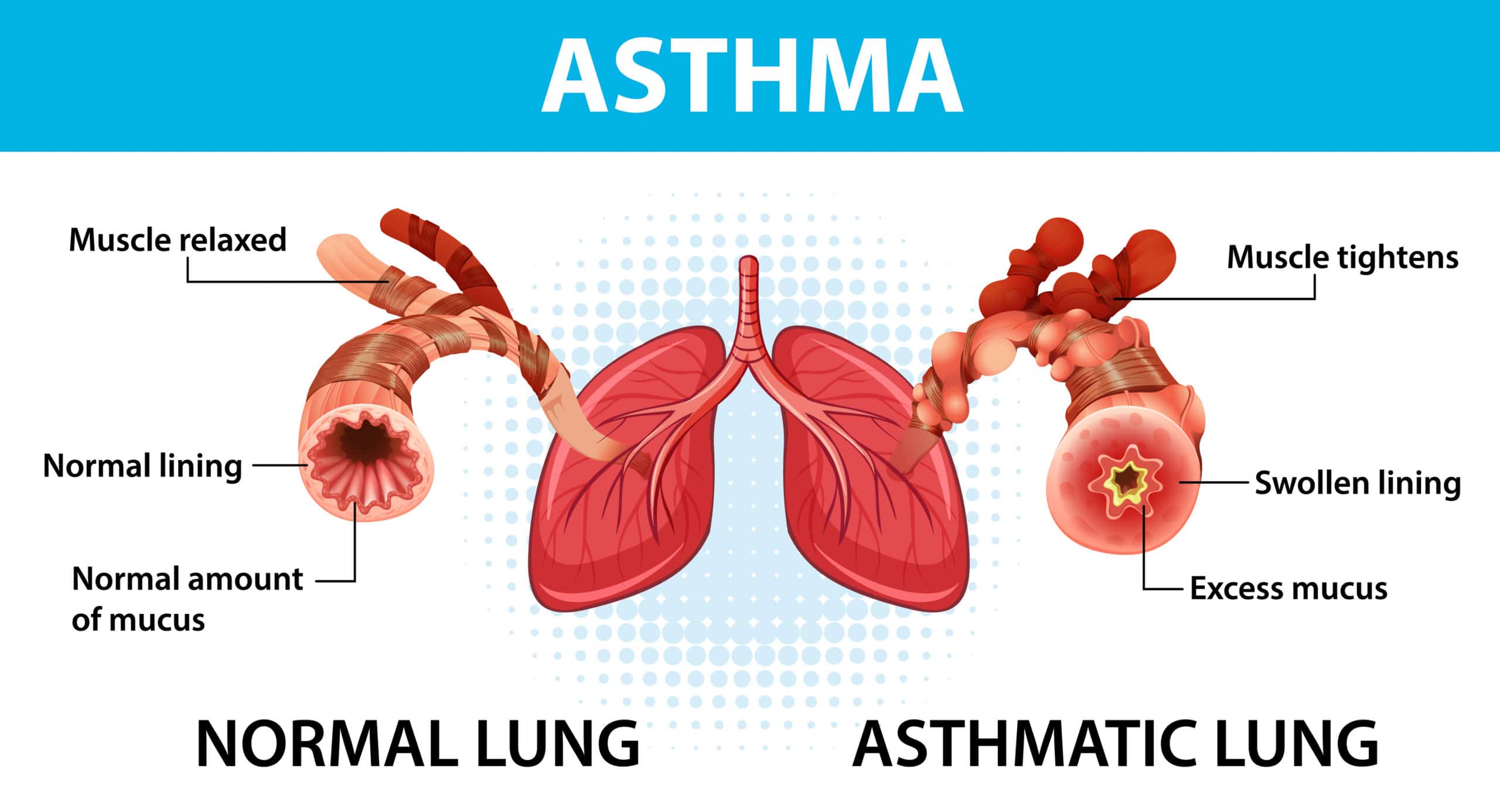 Bronchitis Asthma Meaning In Tamil