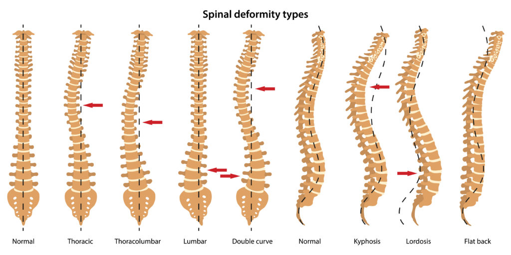 scoliosis types