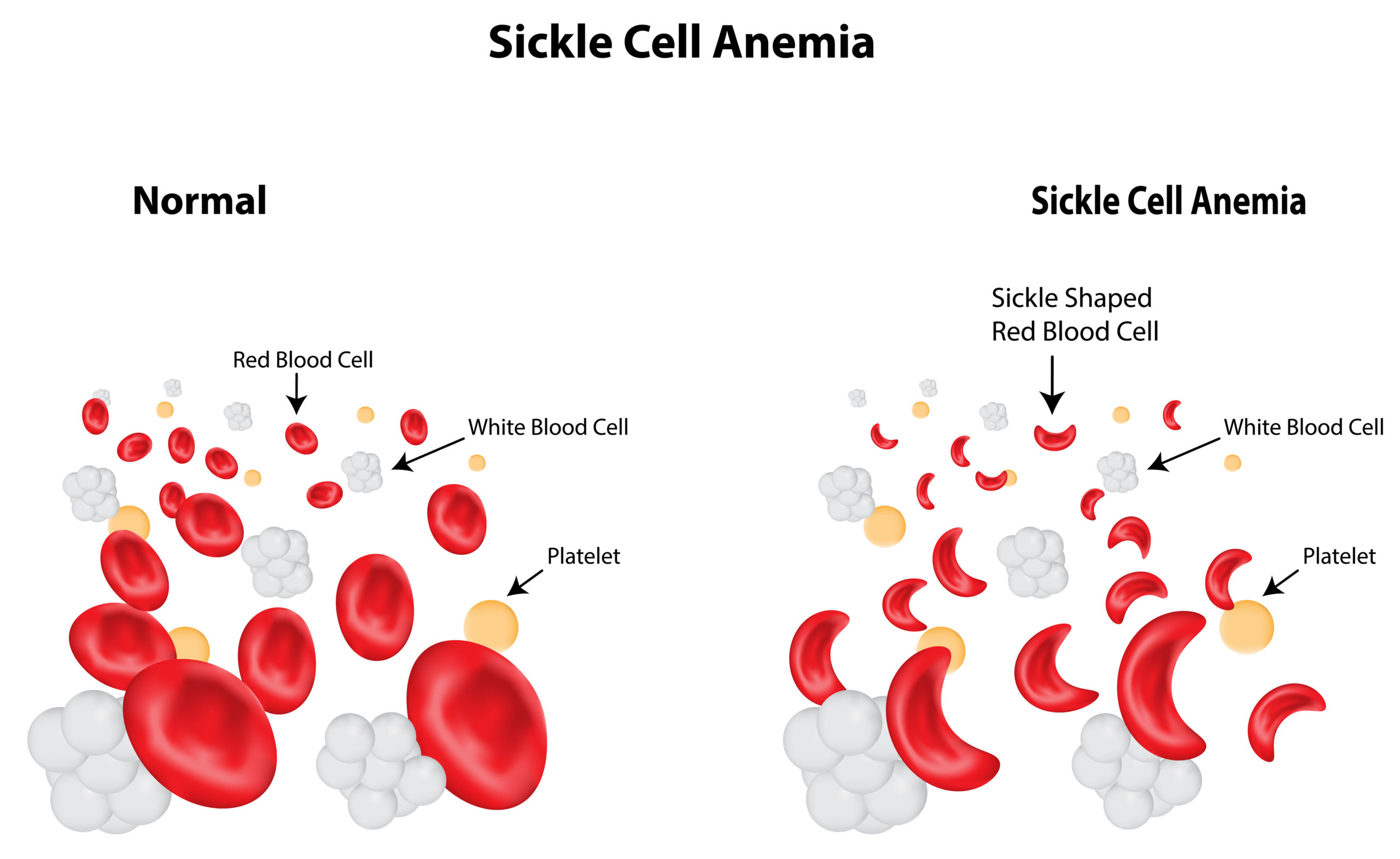 people with sickle cell anemia