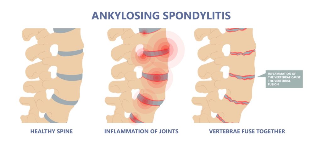 ankylosing spondylitis vertebrae showing inflammation and fusion