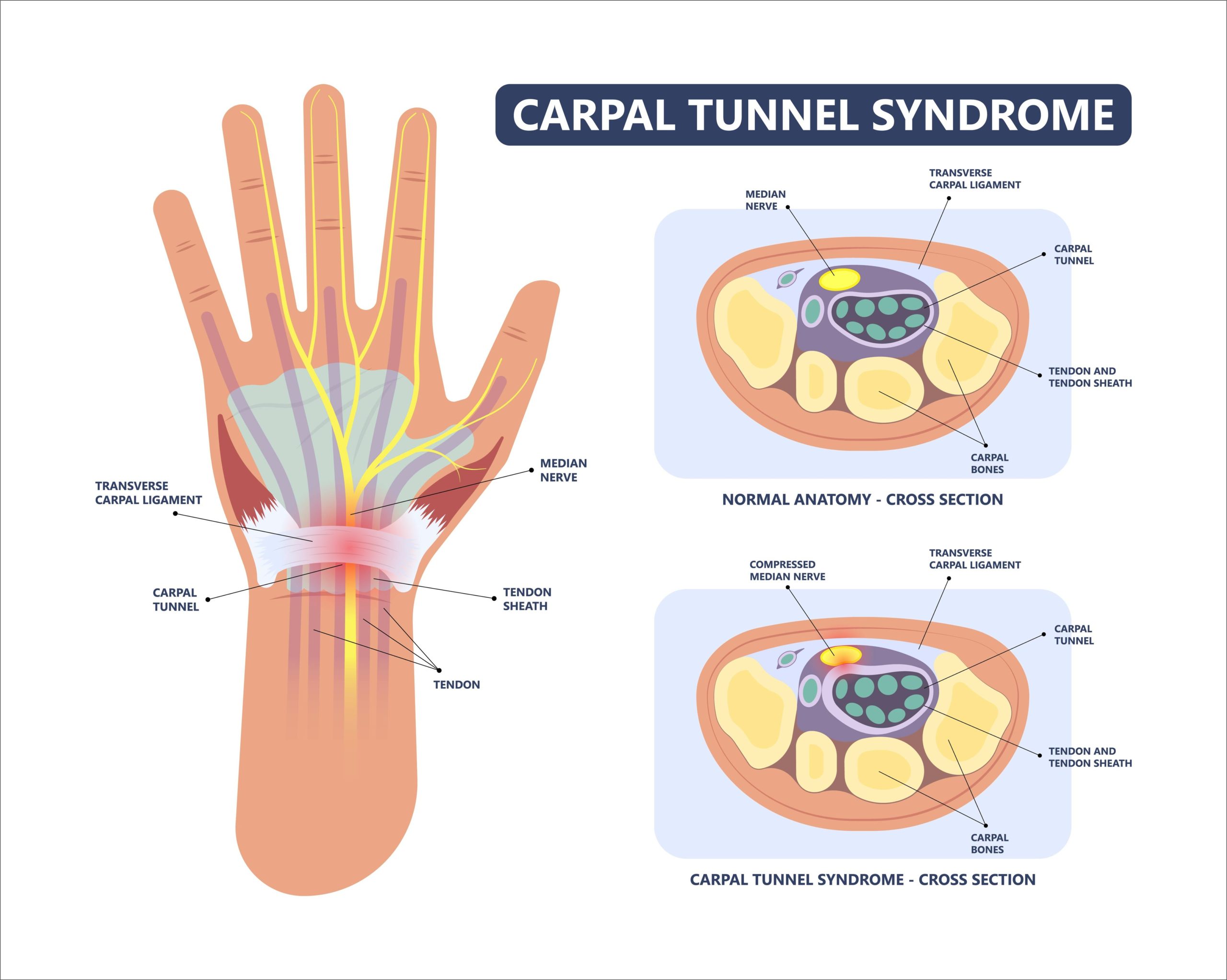 Carpal Tunnel Syndrome - Wrist - Conditions - Musculoskeletal