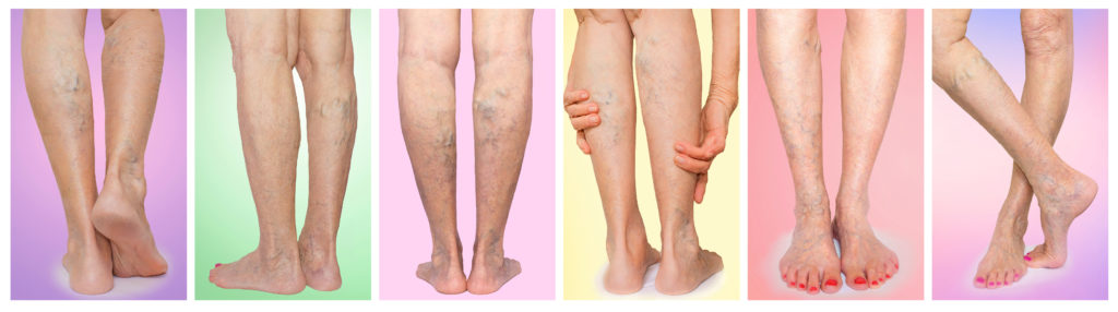 Varicose veins photo of female legs with varicose veins and spider veins at studio. Collage