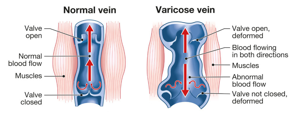 Varicose veins. Illustration showing varicose veins and normal veins