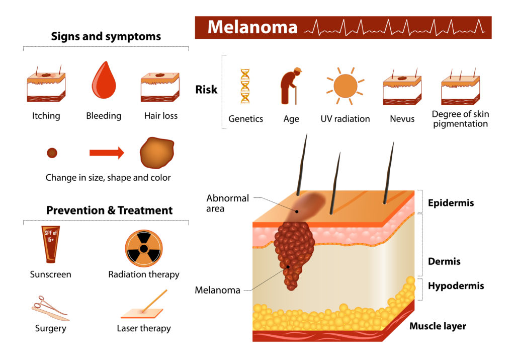 Malignant Melanoma. Skin cancer infographics. Medical Infographic set with icons and other elements.