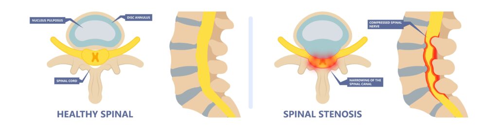 SPINAL STENOSIS - drawing of normal spine and spinal stenosis