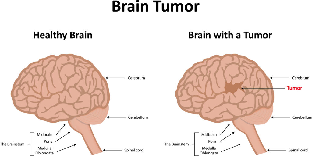 benign brain tumor, two images of brains, one normal brain and one brain with tumor