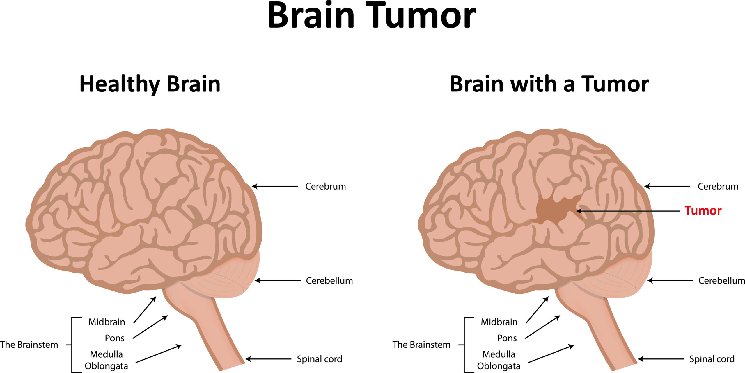 BENIGN BRAIN TUMORS & SSD BENEFITS