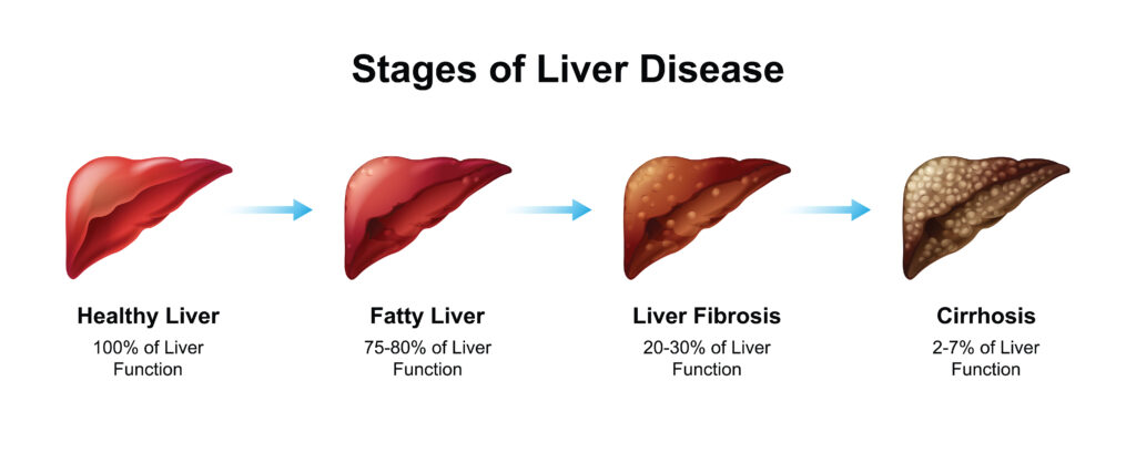 Scientific Designing of Chronic Liver Disease (CLD) Stages.