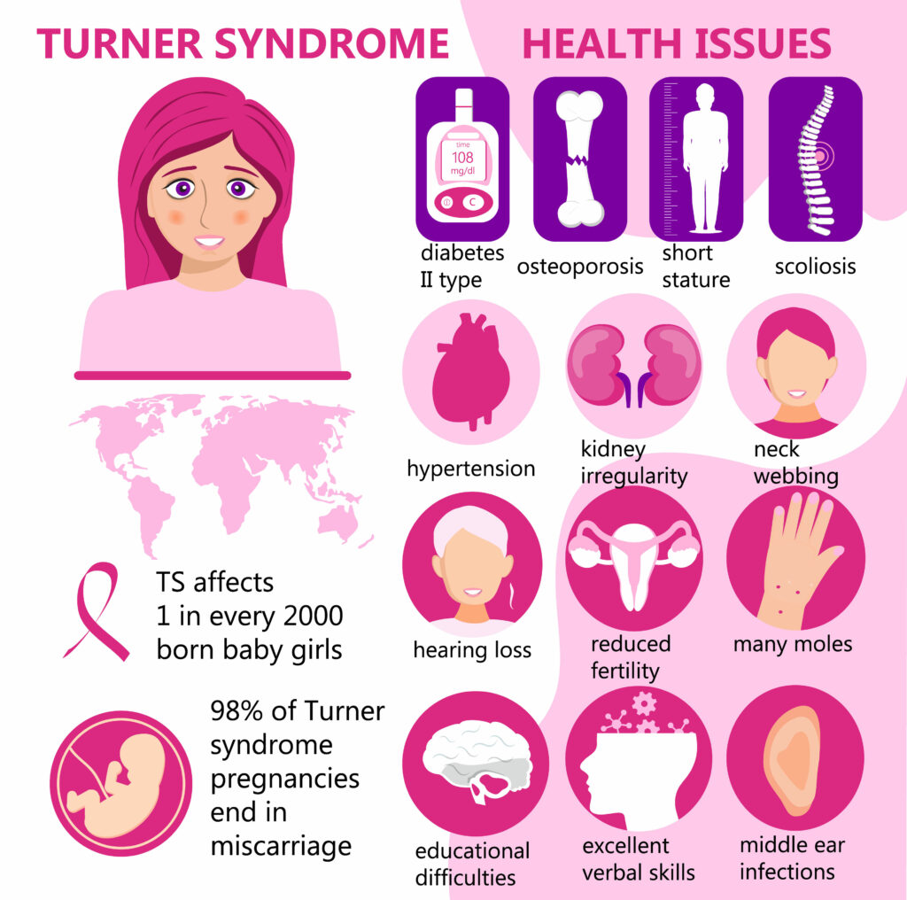Turner syndrome information
