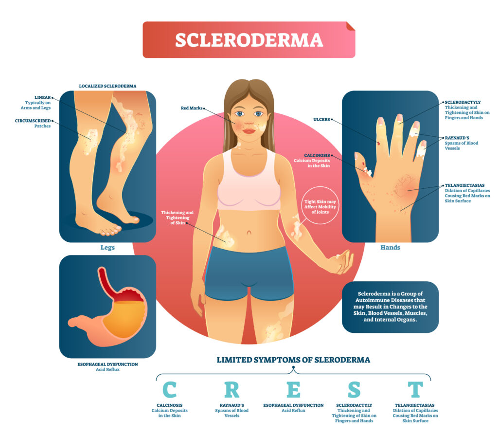 Scleroderma vector illustration. Autoimmune skin, muscles, internal organs and blood disease. Diagram with limited symptoms of illness and examples with location on body.