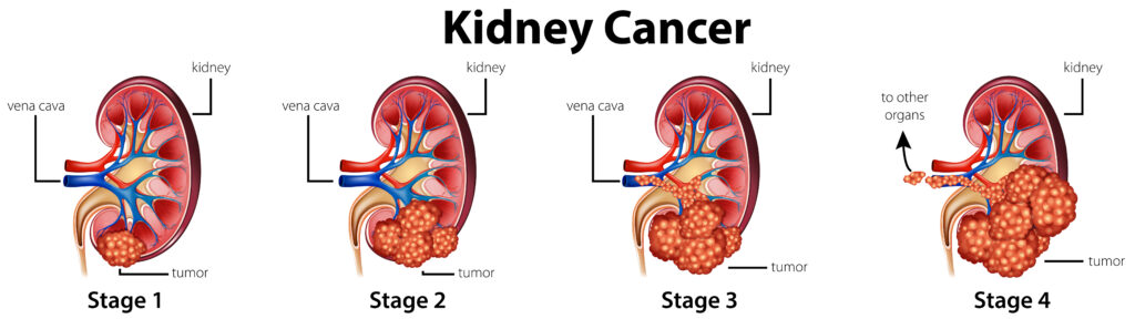 Diagram showing different stages of kidney cancer illustration