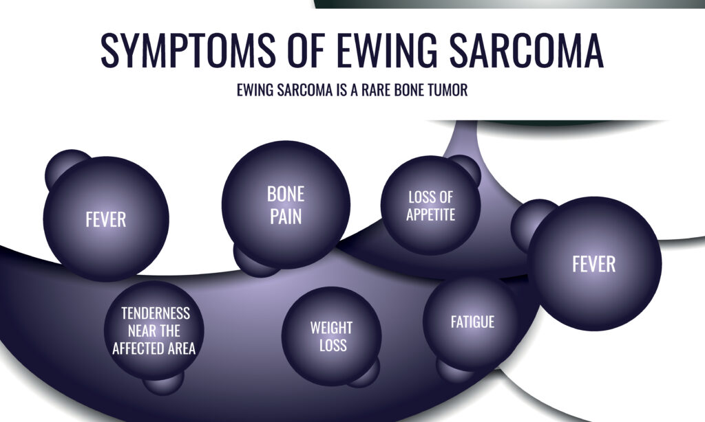 symptoms of Ewing sarcoma. Vector illustration for medical journal or brochure.