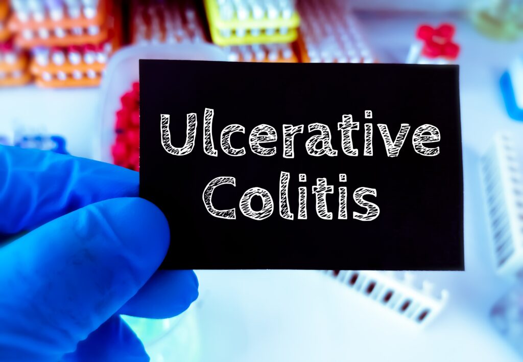 Ulcerative Colitis disease term, a long term condition where the colon and rectum become inflamed